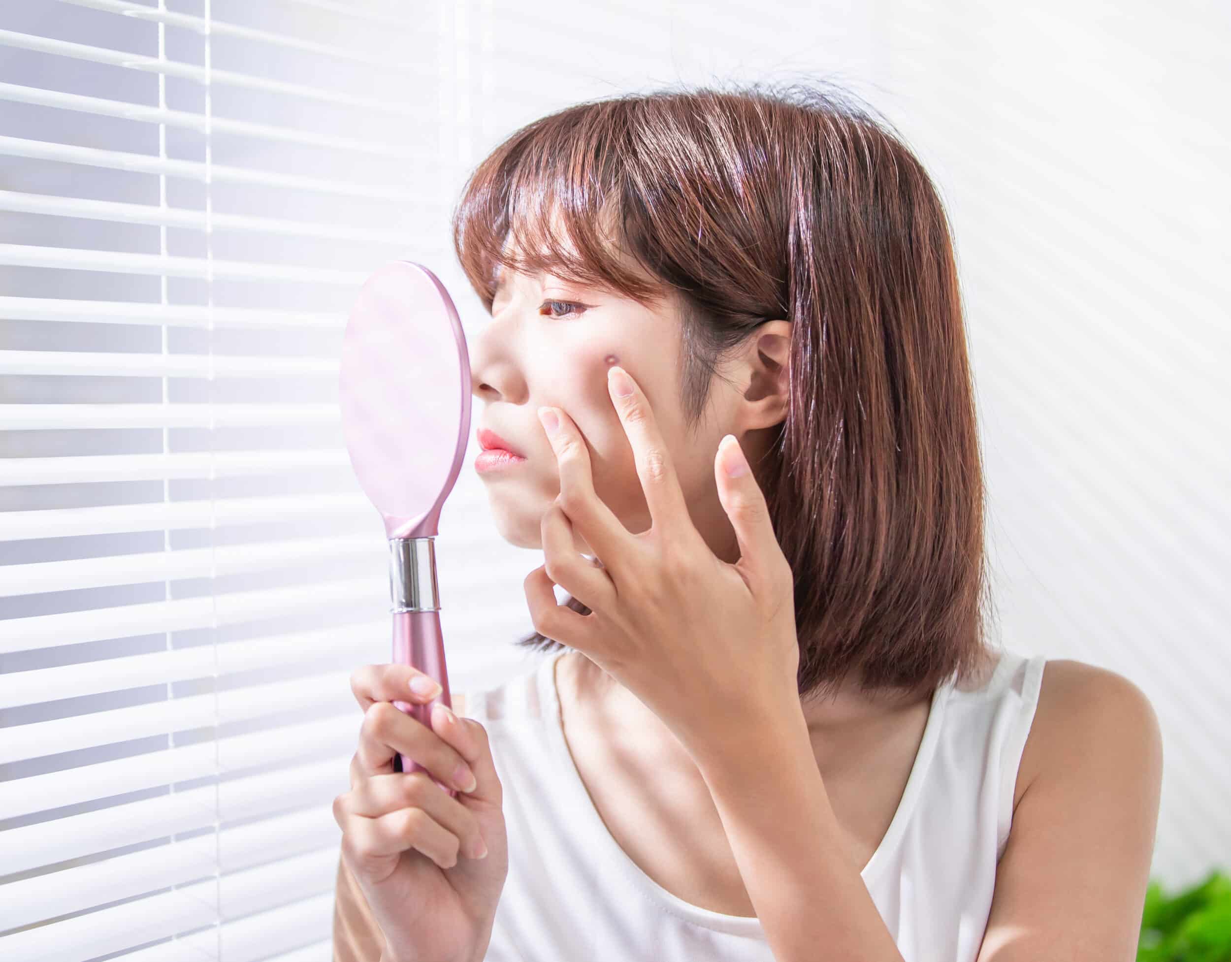 Woman looking sad due to acne-prone skin and visible blemishes on her face