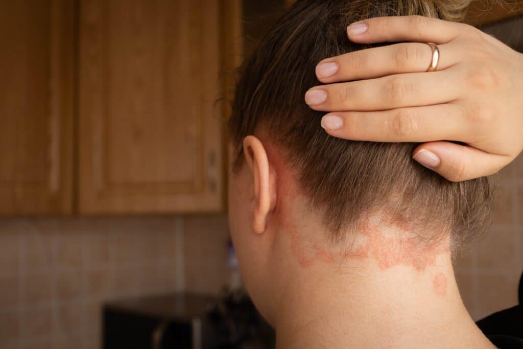 Psoriasis plaques on a girl’s scalp with visible rash and itching, showing symptoms of autoimmune skin disease