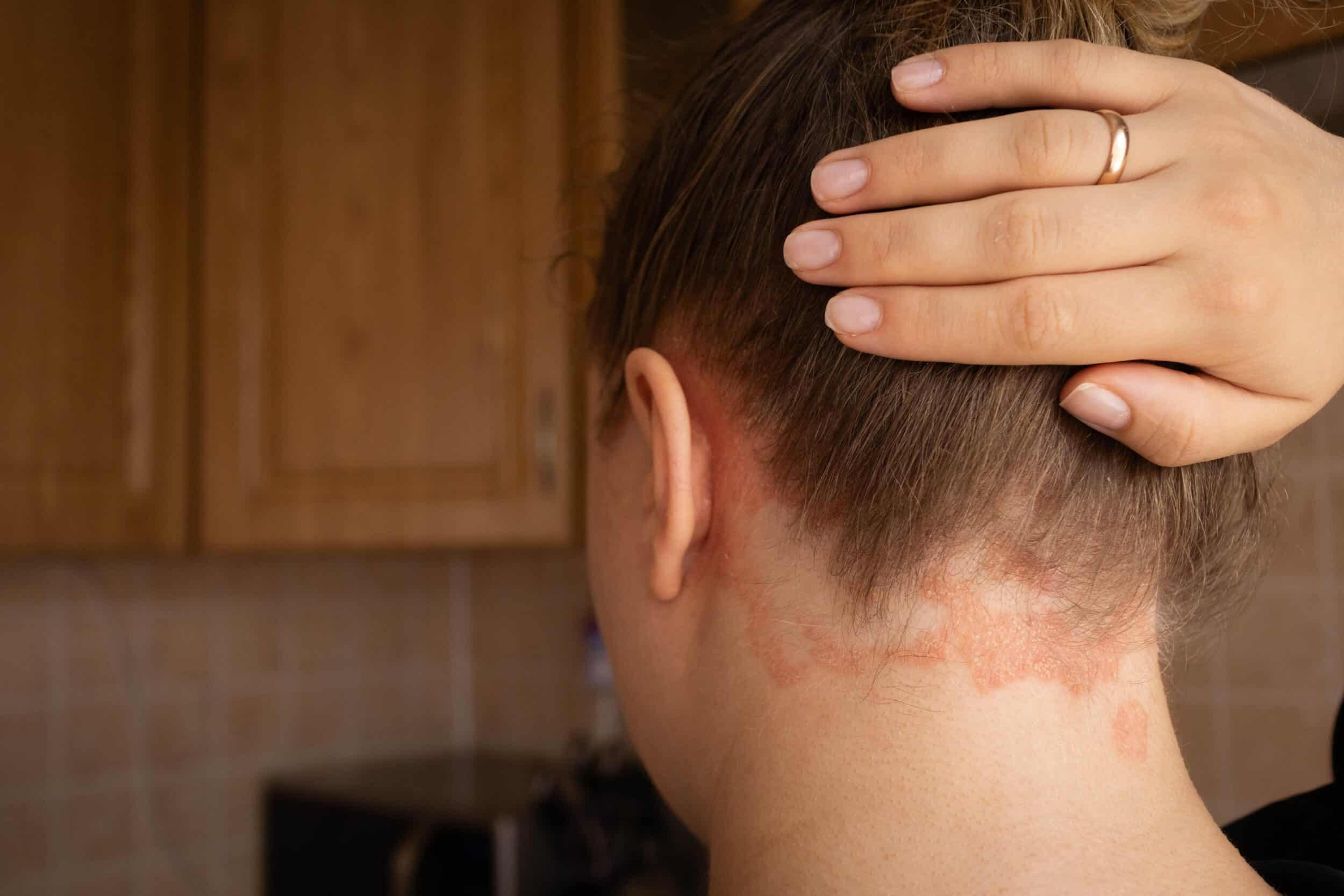 Psoriasis plaques on a girl’s scalp with visible rash and itching, showing symptoms of autoimmune skin disease
