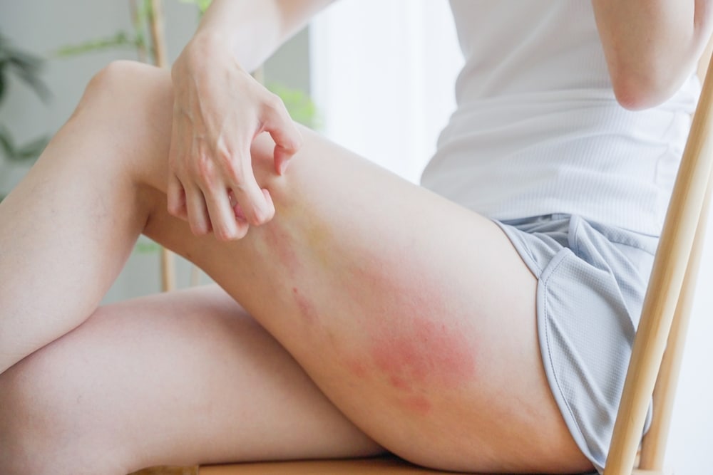 Woman scratching eczema on thigh, showing dry skin irritation and dermatology condition