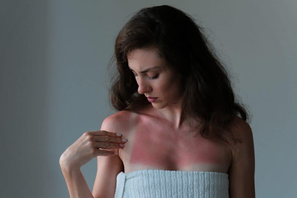 Woman wrapped in towel pointing at red, irritated skin with severe sunburn, highlighting sun damage and need for skin care